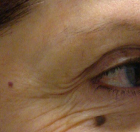 Skin Tightening of Eye Wrinkles with CO2 Laser — before