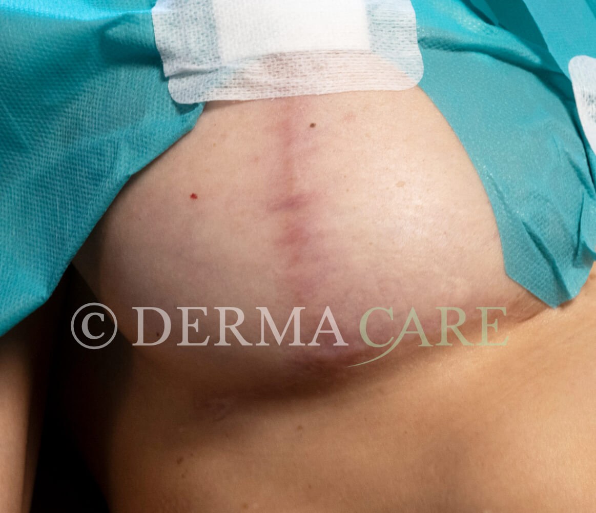 Chest Stem Cell Therapy — before