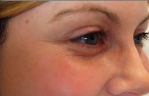 Crow's Feet (Periorbital Lines) — before