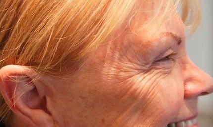 Crow's Feet — before