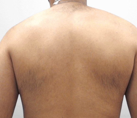 Back Hair Removal — before