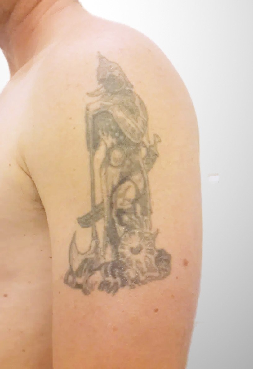 Schwarzes Tattoo am Oberarm — vorher