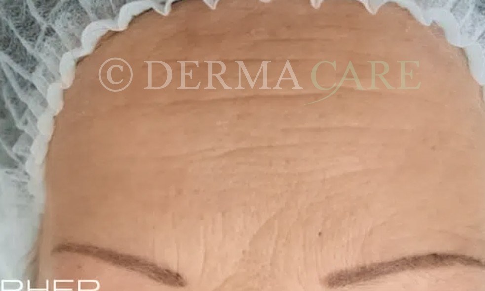 Forehead PQAge Peel — before
