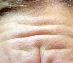 Forehead Lines — before
