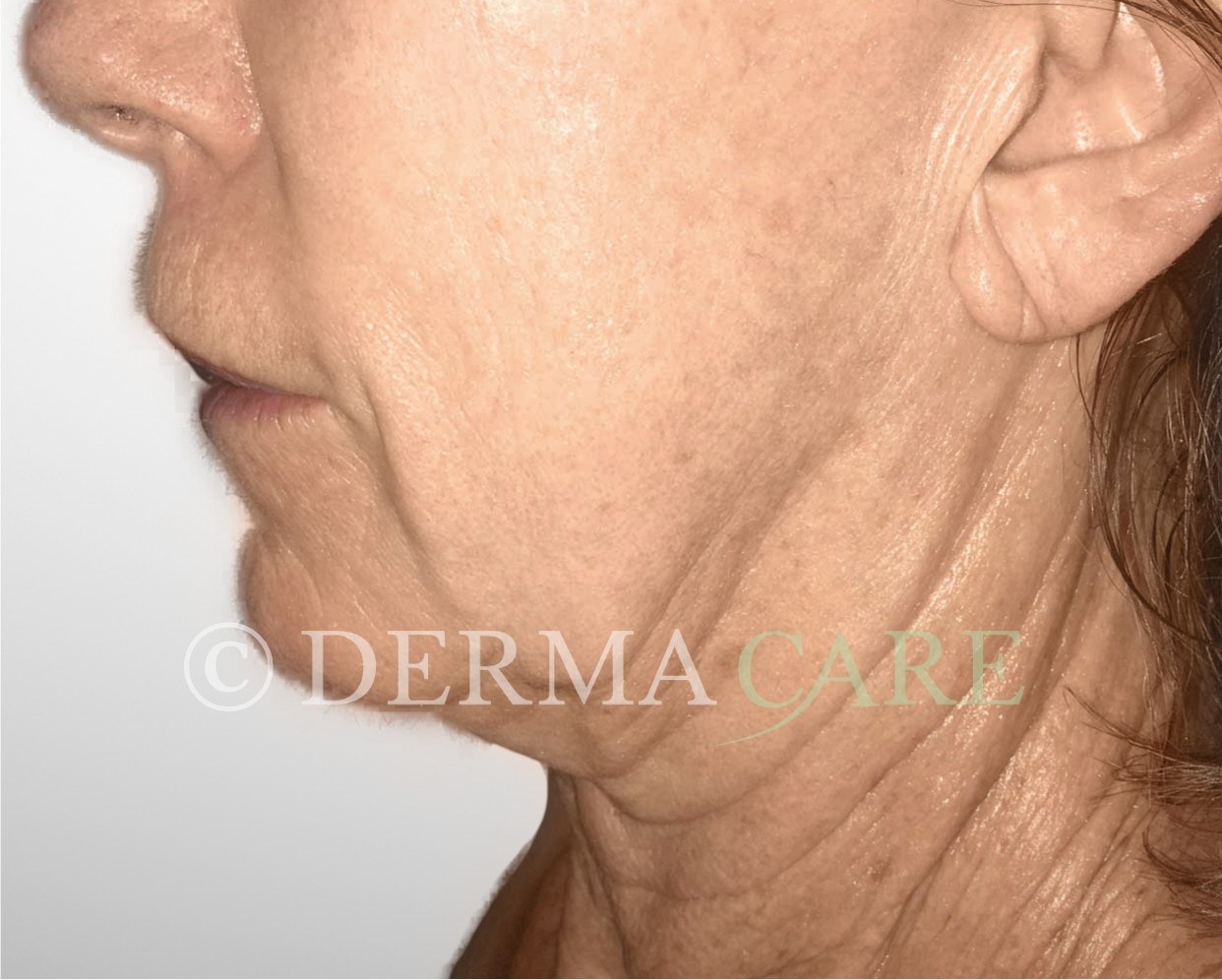 Neck Tightening — before