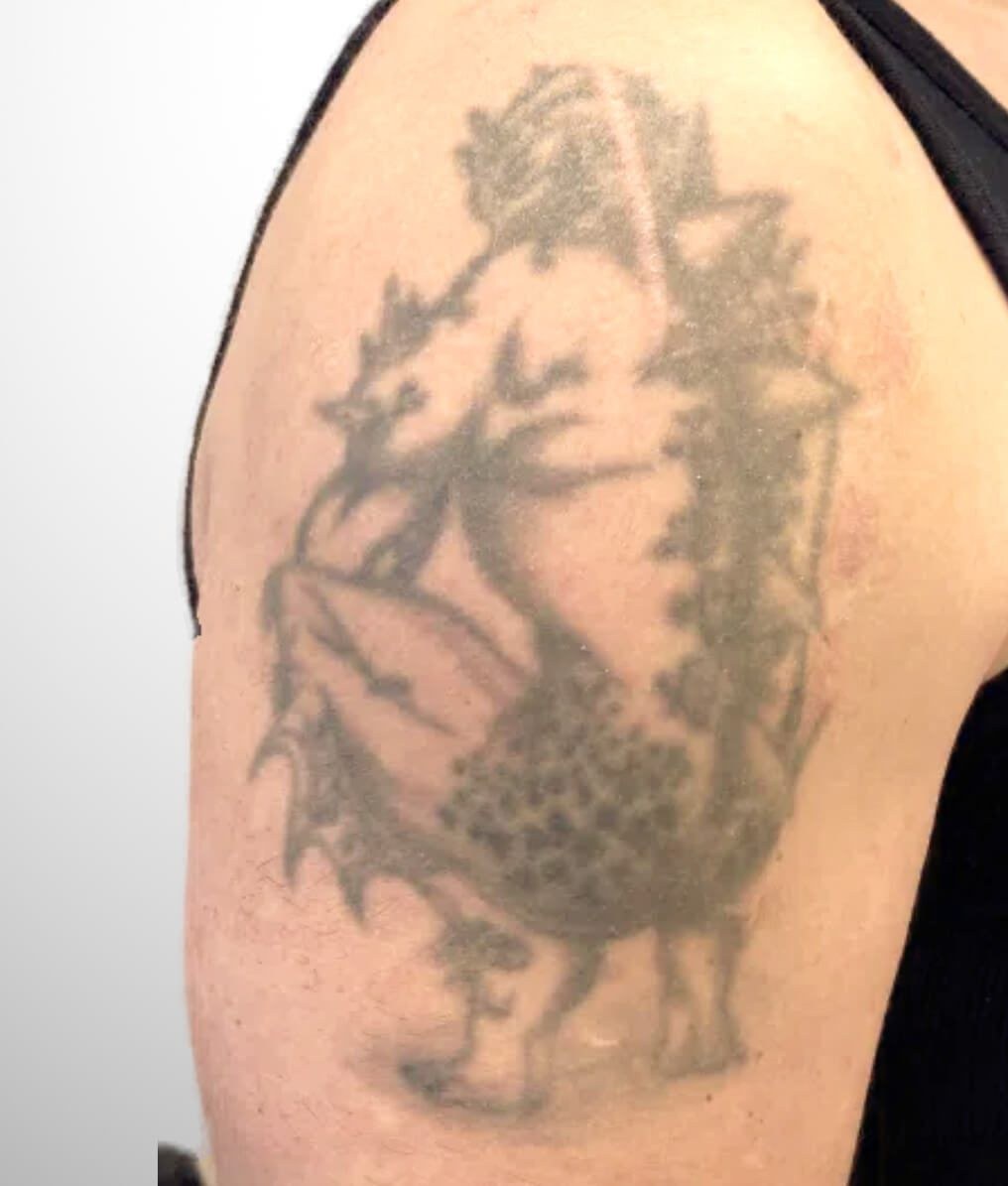Tattooentfernung am Oberarm — vorher