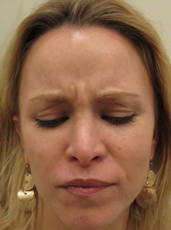 Frown Lines — before
