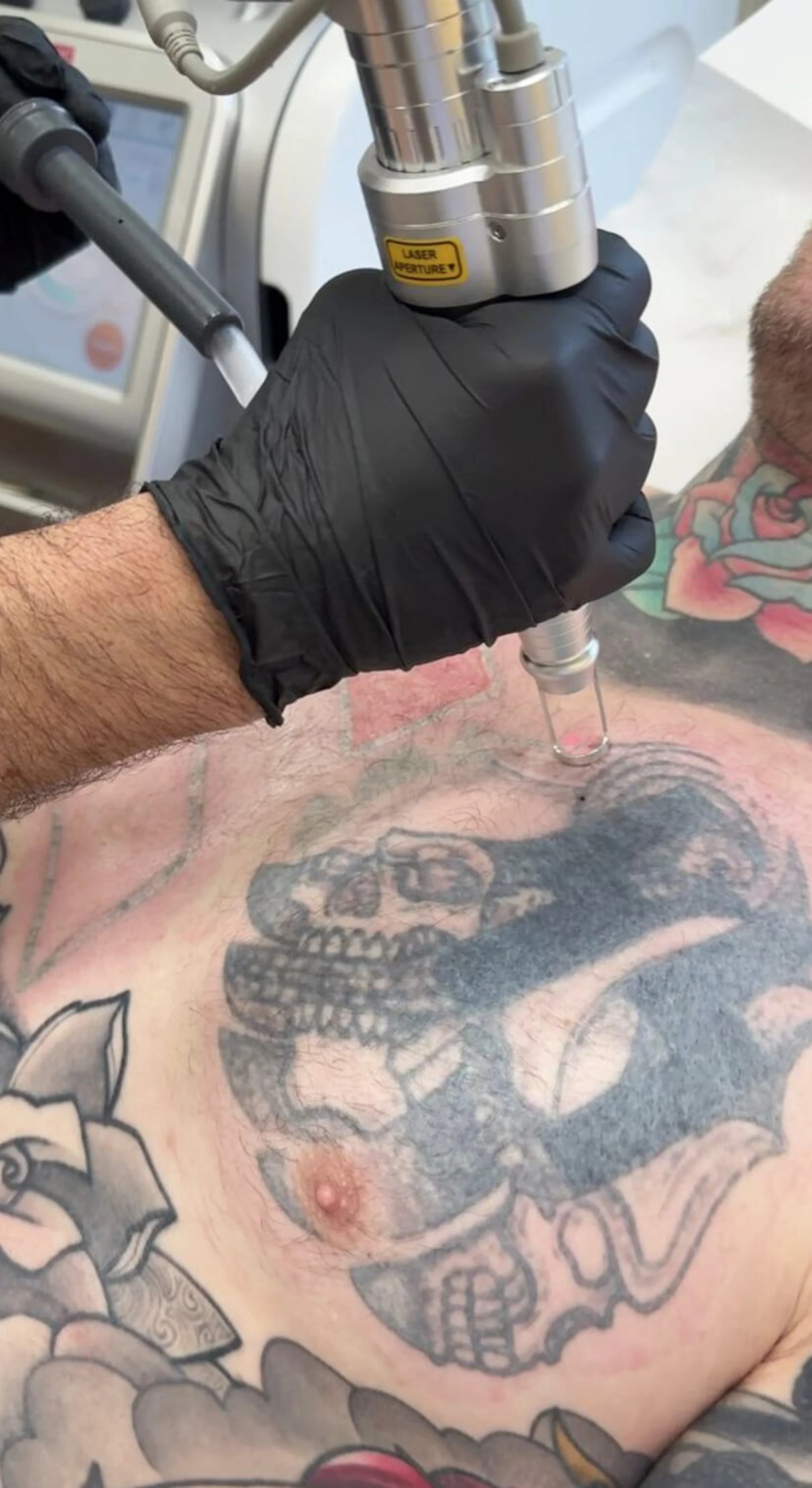 Wenn man sich zwischen Laser vs Cover-up entscheiden müsste und sich eine Laserbehandlung nicht vorstellen kann, so ist dieses Bild der perfekte Einblick in die Tattooentfernung bei Dermacare Wien. Man sieht wie mit dem Pico Laser ein Tattoo auf einer Männerbrust erfolgreich entfernt wird.