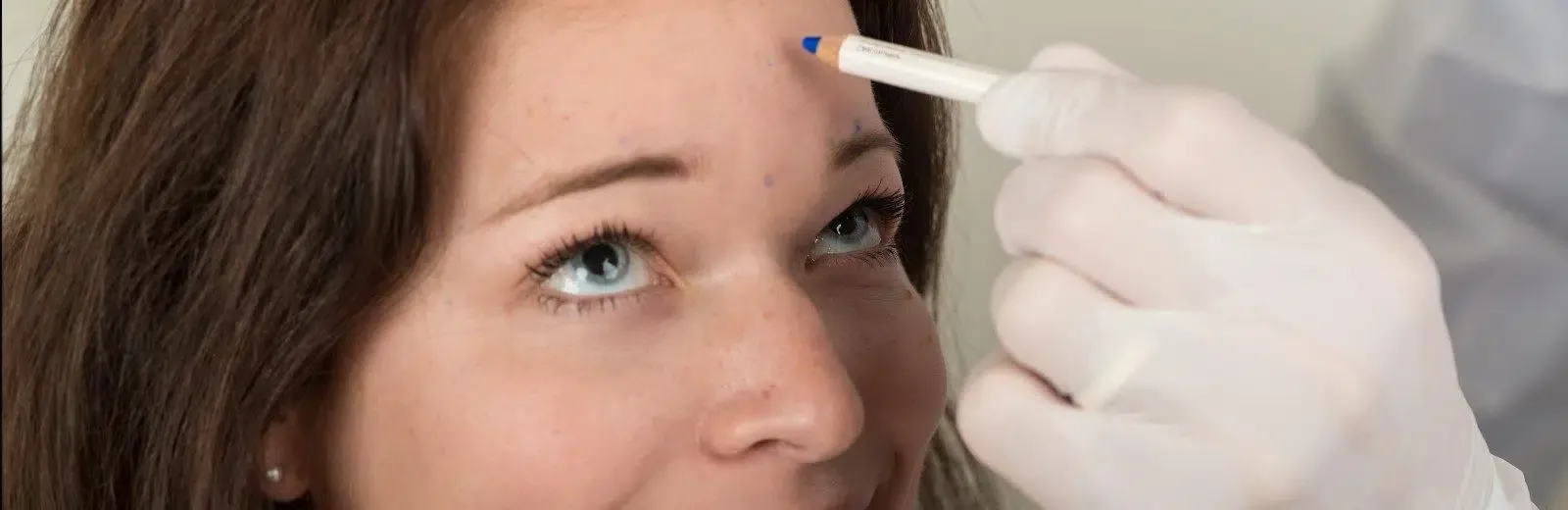 Auf dem Bild sieht man eine Patientin, die sich in einer Vorbereitungsphase für eine Botox-Behandlung bei Dermacare Wien befindet. Der Arzt markiert präzise die Stellen auf der Stirn, an denen das Botulinumtoxin injiziert werden soll, um gezielt Falten zu glätten. Diese Sorgfalt und Genauigkeit spiegeln die hohen Standards bei Dermacare wider, wo transparente Botox Preise Wien und professionelle Betreuung durch erfahrene Fachärzte gewährleistet sind.