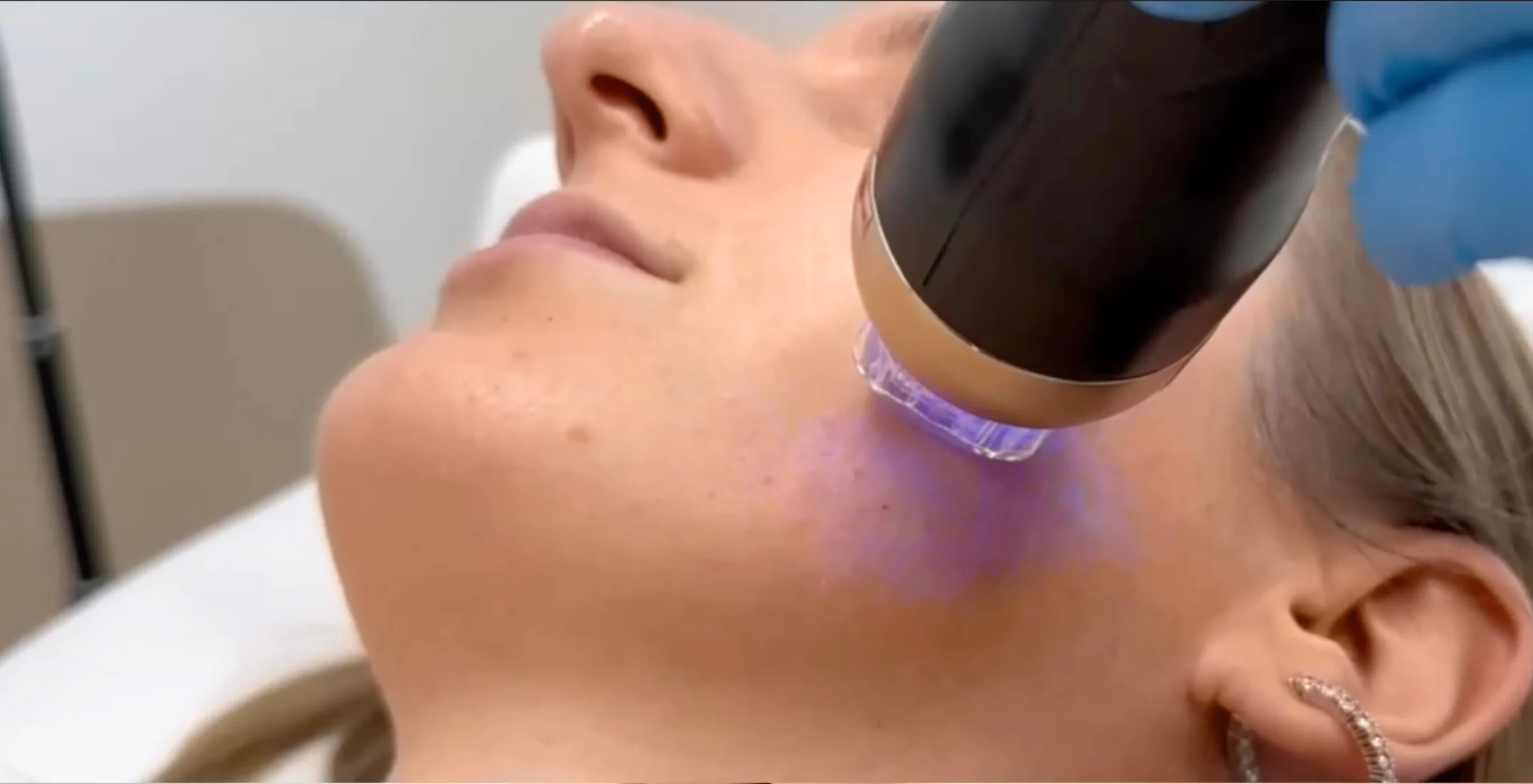 Was ist eine Morpheus8 Behandlung?