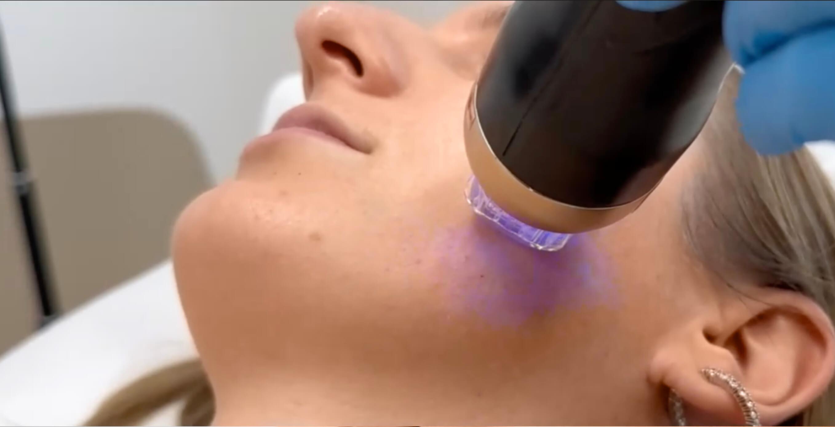 Was ist eine Morpheus8 Behandlung?