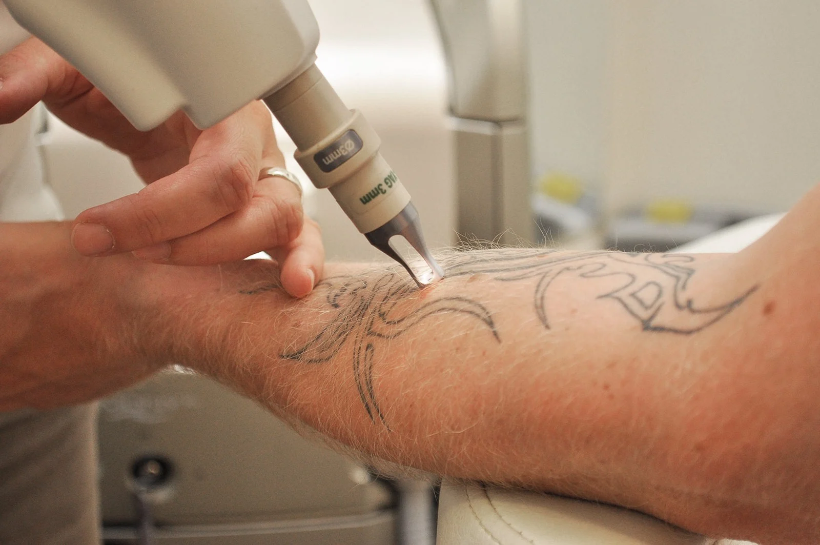 Tattooentfernung Kosten in Wien