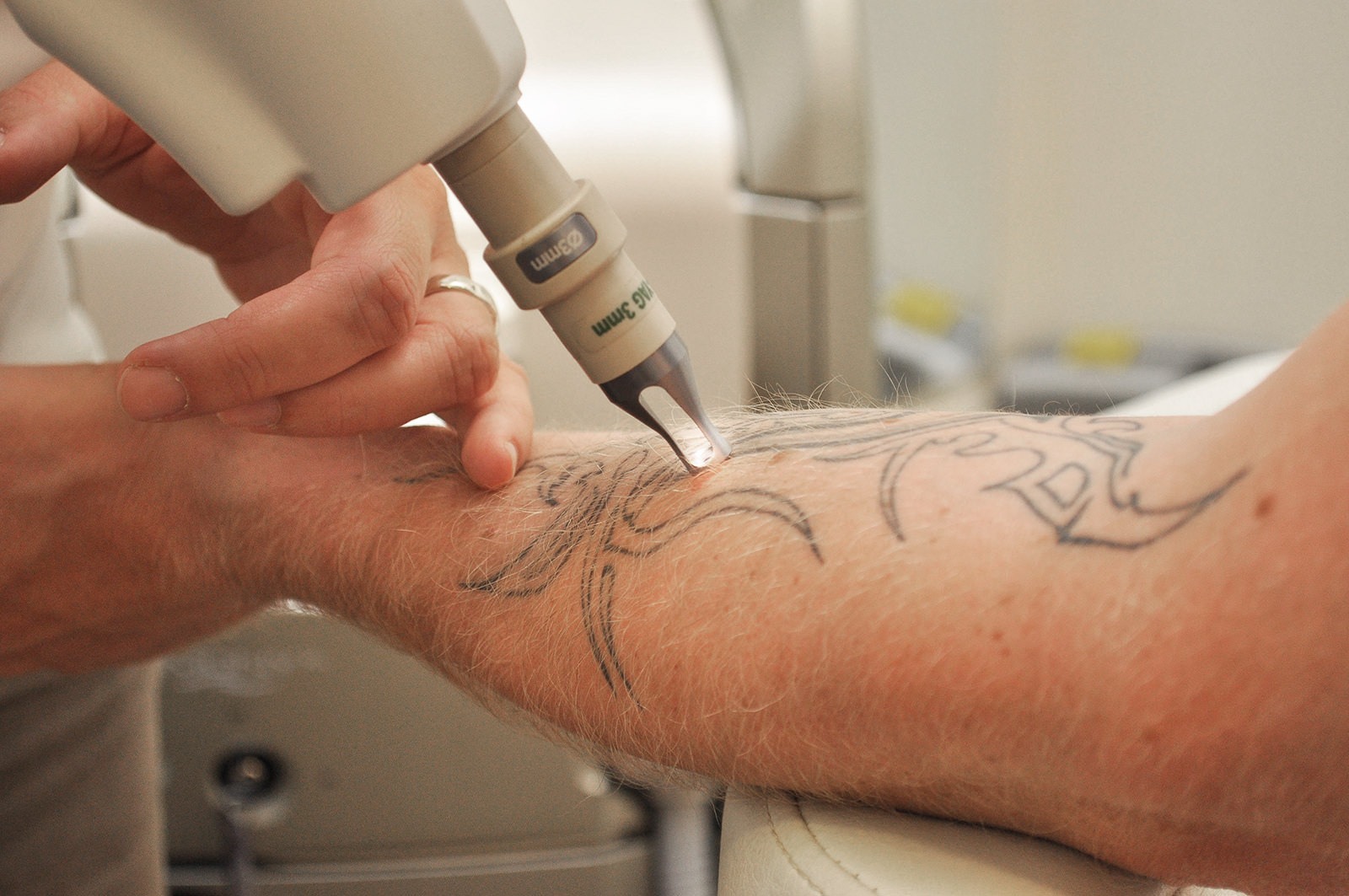Tattooentfernung Kosten in Wien