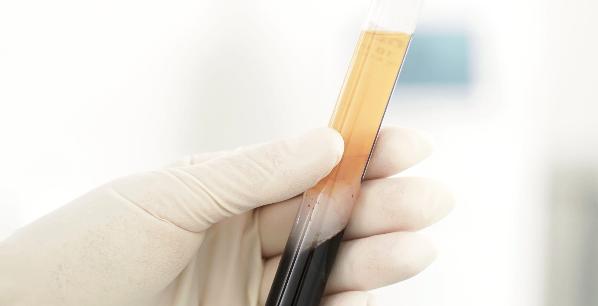 Das Bild zeigt eine behandschuhte Hand, die ein aufbereitetes Röhrchen mit plättchenreichem Plasma (PRP) hält. In der oberen, goldgelben Phase befindet sich das wertvolle Plasma, das im Rahmen der Eigenbluttherapie zur Hautverjüngung eingesetzt wird. Dieses Bild veranschaulicht den natürlichen Ursprung und die medizinisch präzise Vorbereitung der PRP-Behandlung – eine innovative Methode, die bei der Faltenbehandlung bei Dermacare gezielt mit anderen Verfahren wie der Faltenbehandlung mit Hyaluronsäure kombiniert wird. Das Ziel: frische, strahlende Haut durch körpereigene Regeneration und gezielte Faltenglättung – ganz ohne künstlichen Look.