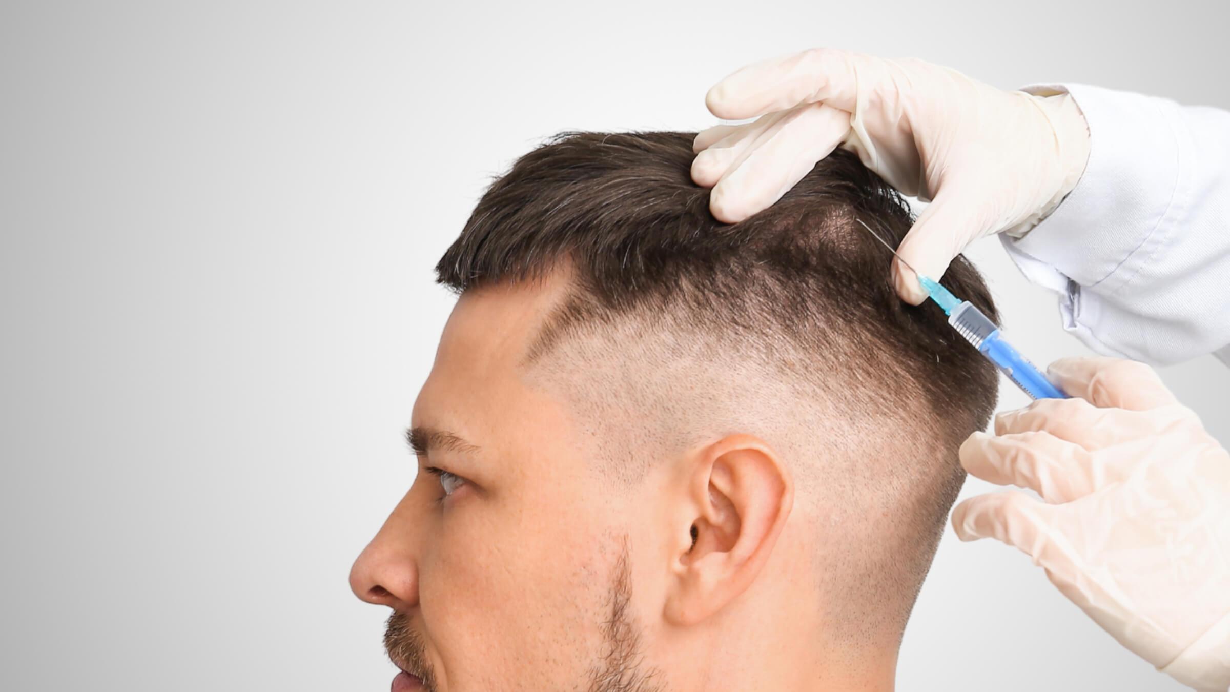 Das Bild zeigt einen Mann, der eine Haarbehandlung erhält. Ein Arzt trägt medizinische Handschuhe und injiziert eine Flüssigkeit mit einer Spritze in die Kopfhaut des Patienten, spezifisch in den Bereich des Oberkopfs, der auf Haarausfall hinweist. Diese Art der Behandlung könnte eine Eigenbluttherapie (PRP) sein, bei der Plasma aus dem eigenen Blut des Patienten in die Kopfhaut injiziert wird, um das Haarwachstum anzuregen. Die Behandlung wird bei Dermacare Wien angeboten, einem führenden Anbieter für ästhetische Behandlungen, einschließlich Haartransplantation Wien und PRP-Therapien für Haarausfall.