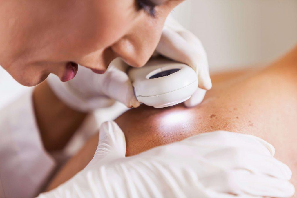 Hautkrebsvorsorge & Muttermalkontrolle – Dermatologische Leistungen bei Dermacare