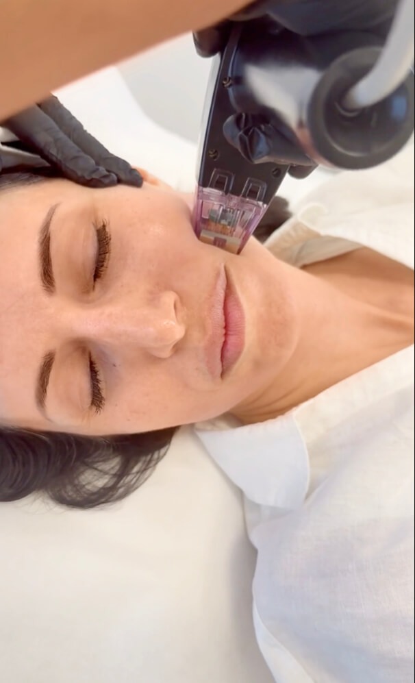 Hier sieht man wie eine Patientin im Gesicht eine RF Microneedling Behandlung bekommt. Feine Nadeln dringend schonend in ihre Haut ein. Sie wirkt sehr entspannt