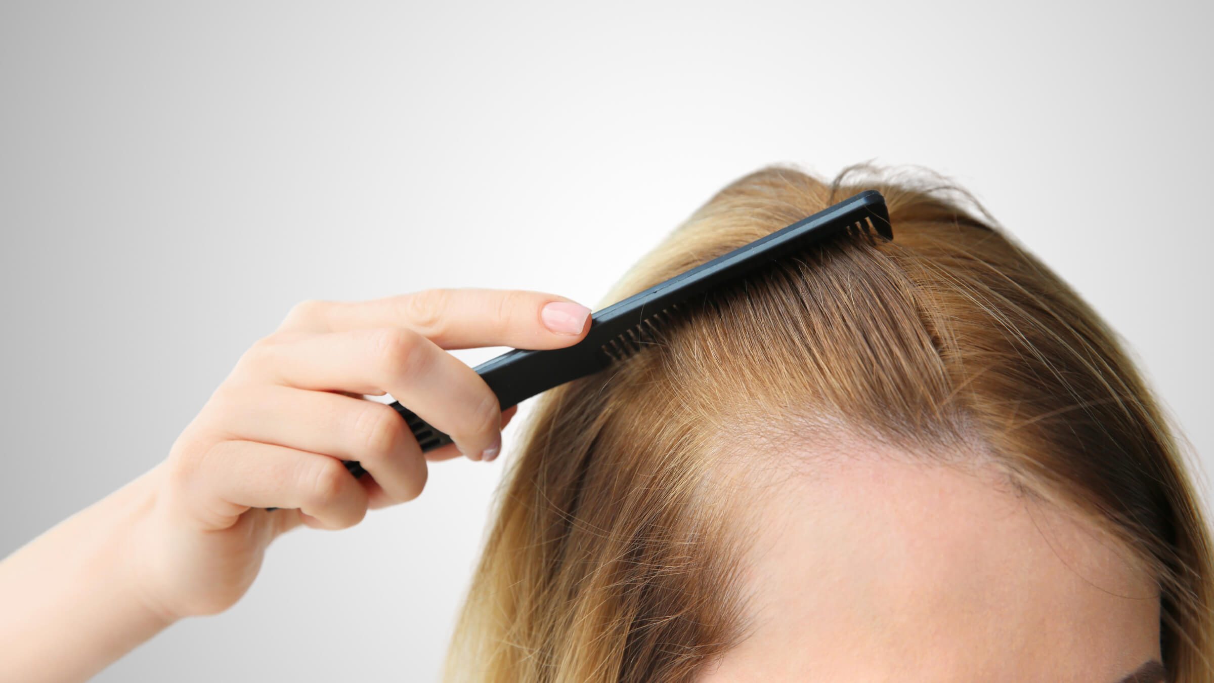 Haarverpflanzung mit FUE-Methode