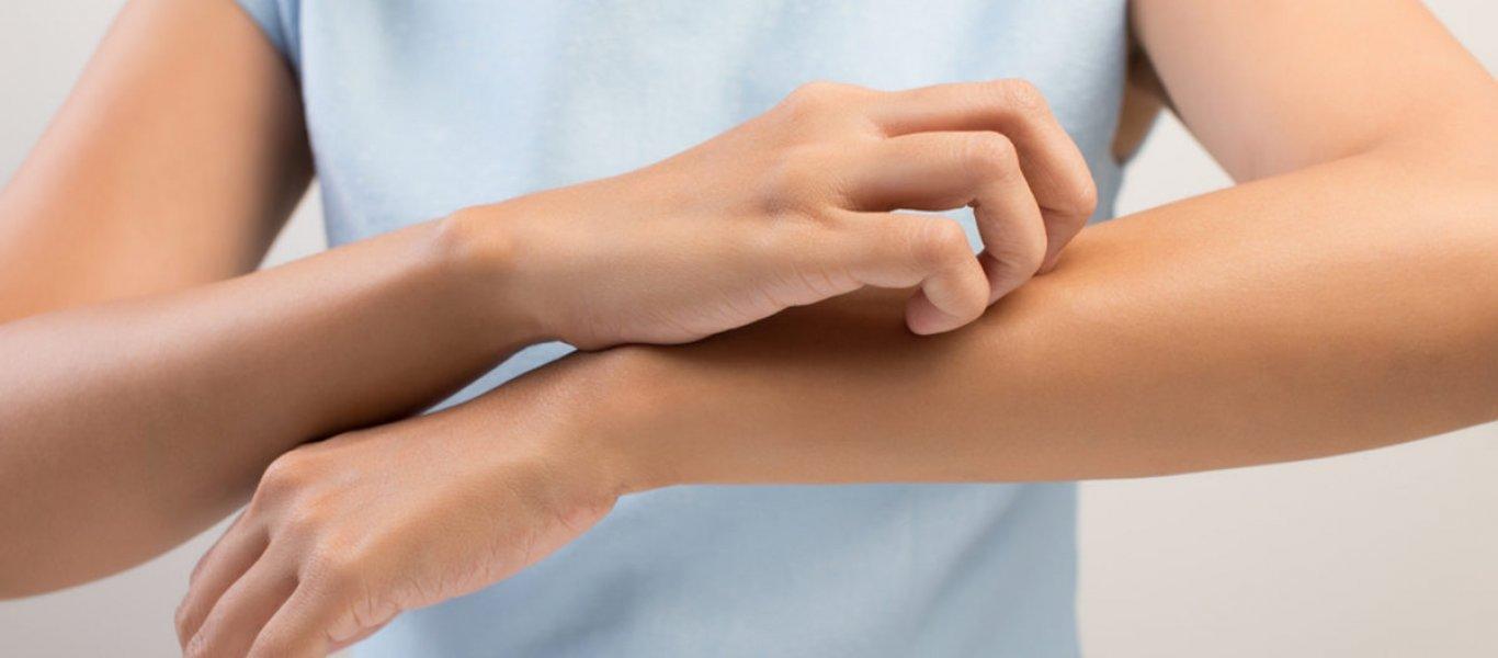 Behandlung von Neurodermitis Wien
