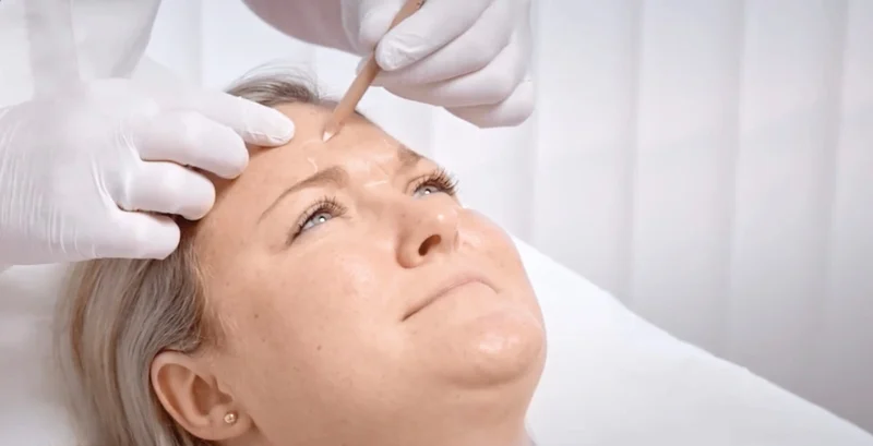 Botox-Behandlung der Stirn bei Dermacare Wien