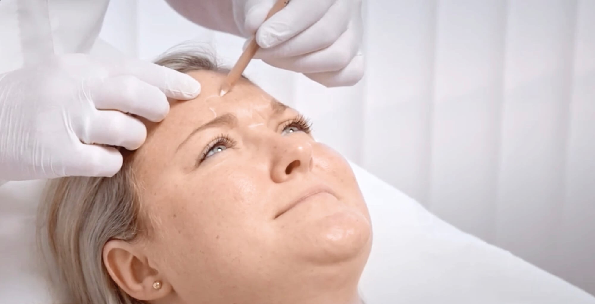 Botox-Behandlung der Stirn bei Dermacare Wien