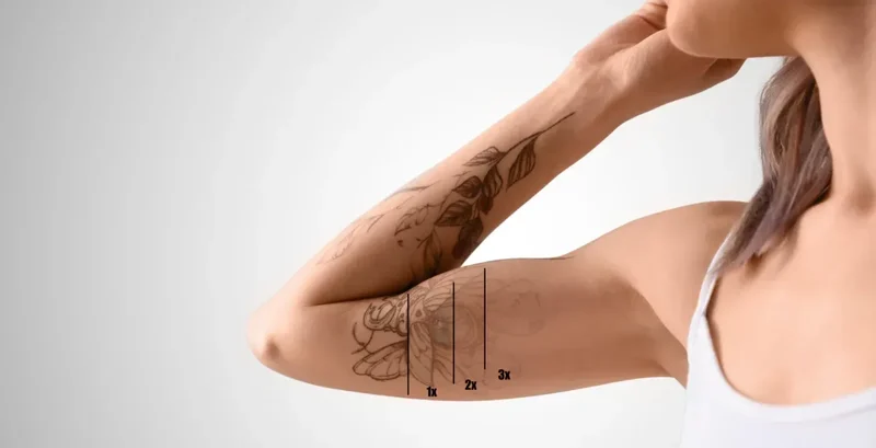 Tattooentfernung mit Pikosekunden-Laser bei Dermacare Wien
