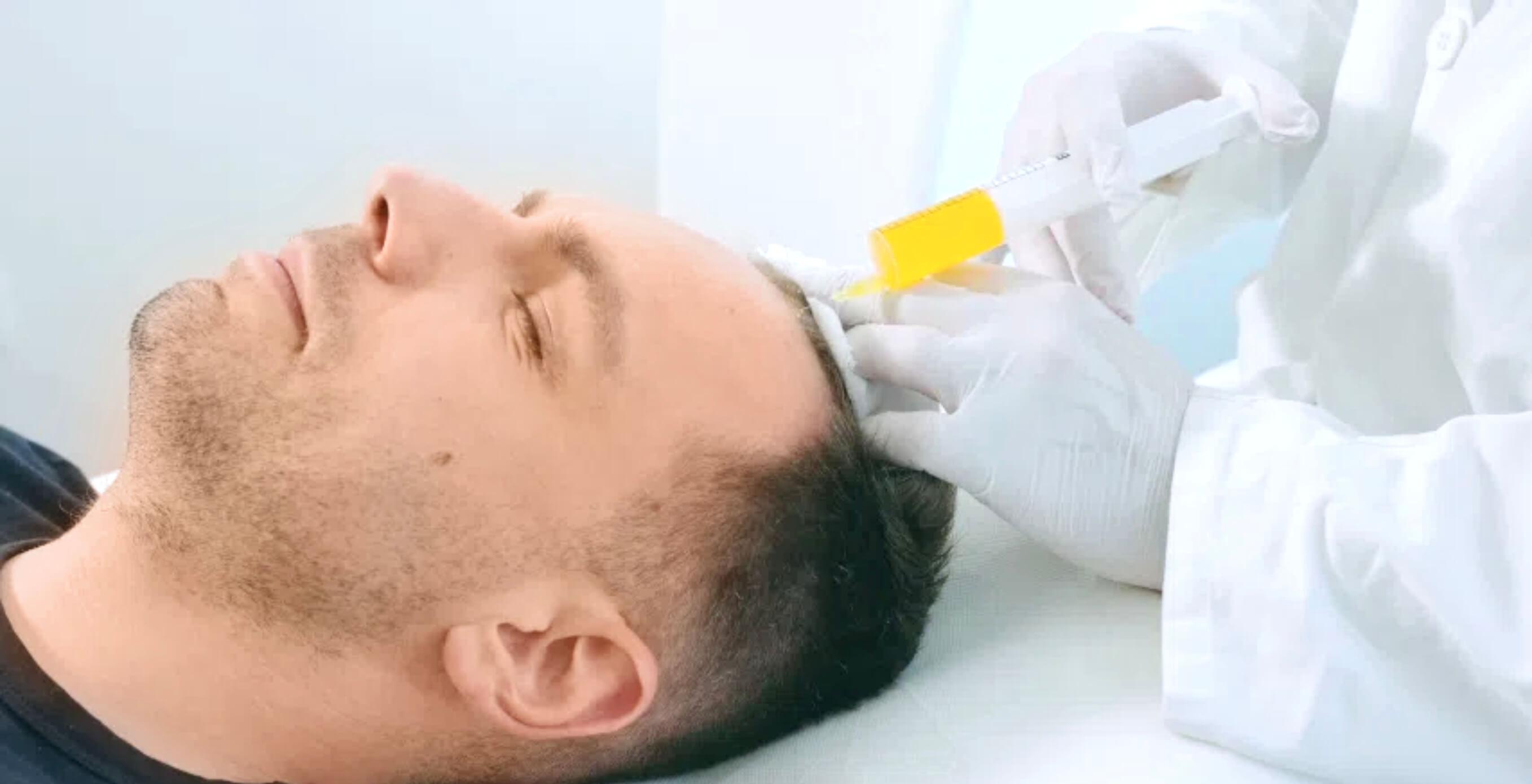 Haarausfallbehandlung mit PRP