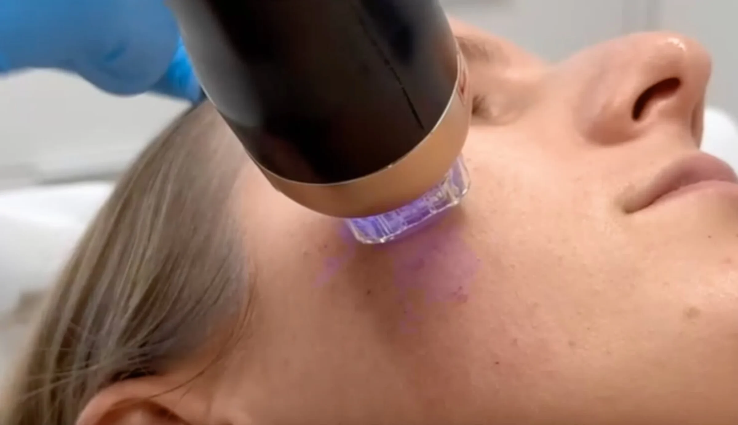Auf diesem Bild sieht man eine Frau bei der gerade Radiofrequenz Microneedling bei Akne angewendet wird. Man sieht das Gerät mit blauem Licht nah auf der Haut.