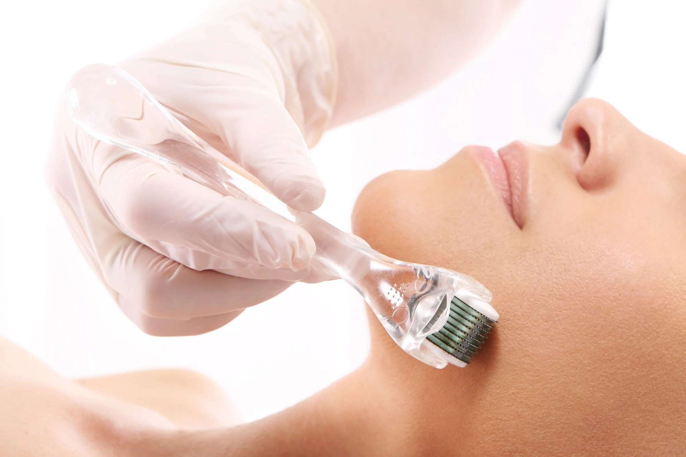 Dermaroller Micro-Needling in Wien für eine ebenmäßige Haut