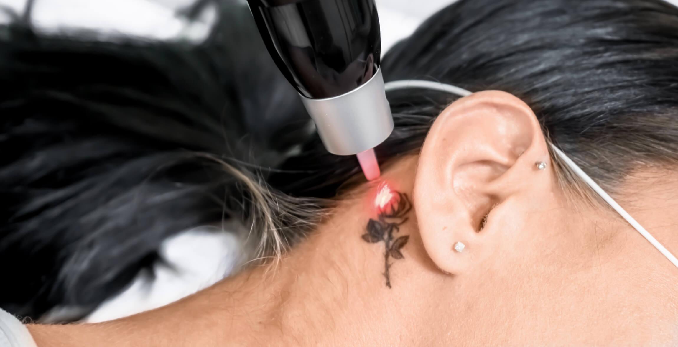 Tattoo überstechen oder entfernen – Laser vs. Cover-Up