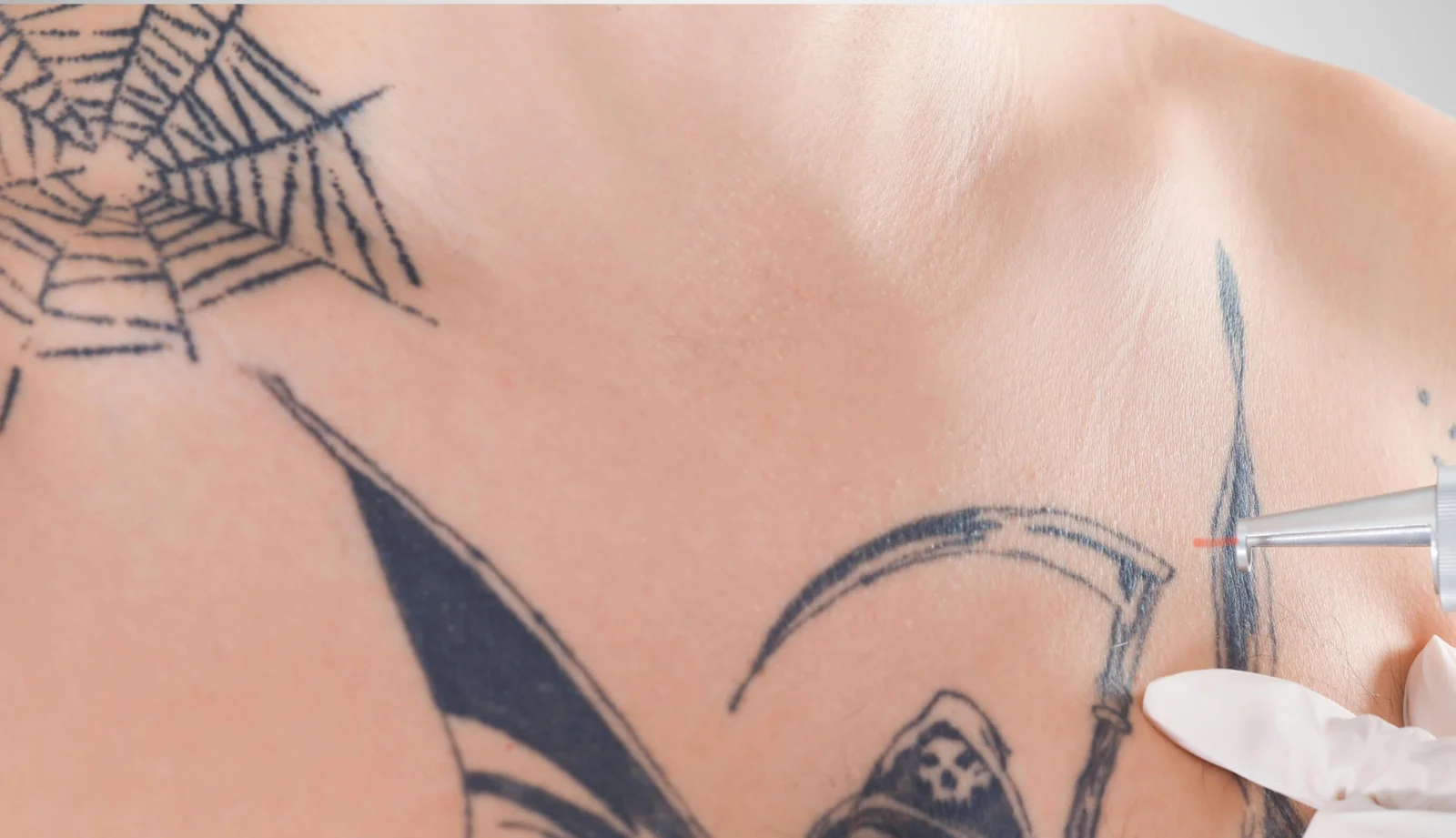 Das Bild zeigt die Behandlung zum Tattoo Aufhellen bei Dermacare Wien. Hier wird ein großes, schwarzes Brust-Tattoo mit einem speziellen Laser bearbeitet, um die dunklen Linien aufzuhellen. Zu sehen ist eine Spinnenweben- und Sensenmotiv-Tätowierung, wobei der Laser punktgenau eingesetzt wird, um die Farbpigmente in der Haut zu reduzieren. Die Vorbereitungen zur Aufhellung dieses Tattoos schaffen die Voraussetzung für ein gelungenes Cover Up. Diese präzise Laserbehandlung bei Dermacare in Wien ist ideal, um dunkle oder alte Tätowierungen zu bearbeiten und Raum für neue Designs zu schaffen.