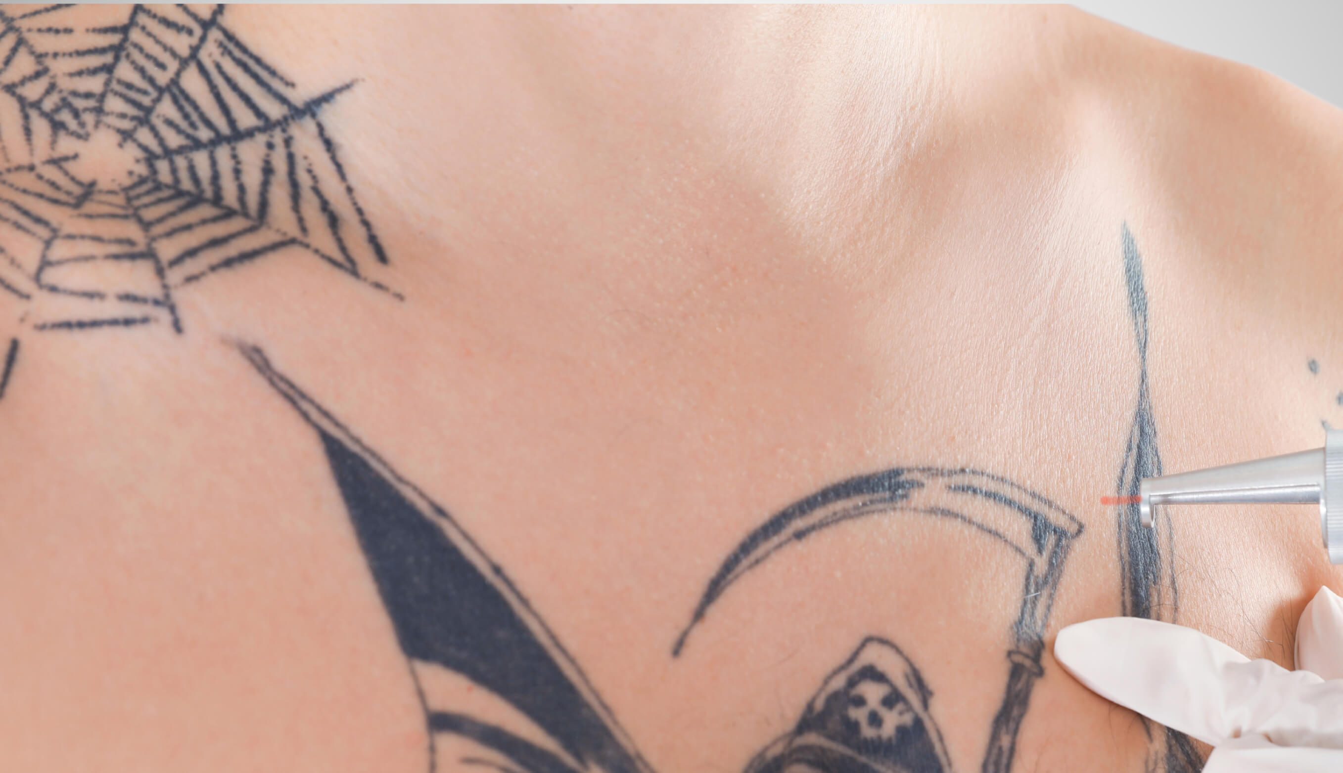 Das Bild zeigt die Behandlung zum Tattoo Aufhellen bei Dermacare Wien. Hier wird ein großes, schwarzes Brust-Tattoo mit einem speziellen Laser bearbeitet, um die dunklen Linien aufzuhellen. Zu sehen ist eine Spinnenweben- und Sensenmotiv-Tätowierung, wobei der Laser punktgenau eingesetzt wird, um die Farbpigmente in der Haut zu reduzieren. Die Vorbereitungen zur Aufhellung dieses Tattoos schaffen die Voraussetzung für ein gelungenes Cover Up. Diese präzise Laserbehandlung bei Dermacare in Wien ist ideal, um dunkle oder alte Tätowierungen zu bearbeiten und Raum für neue Designs zu schaffen.