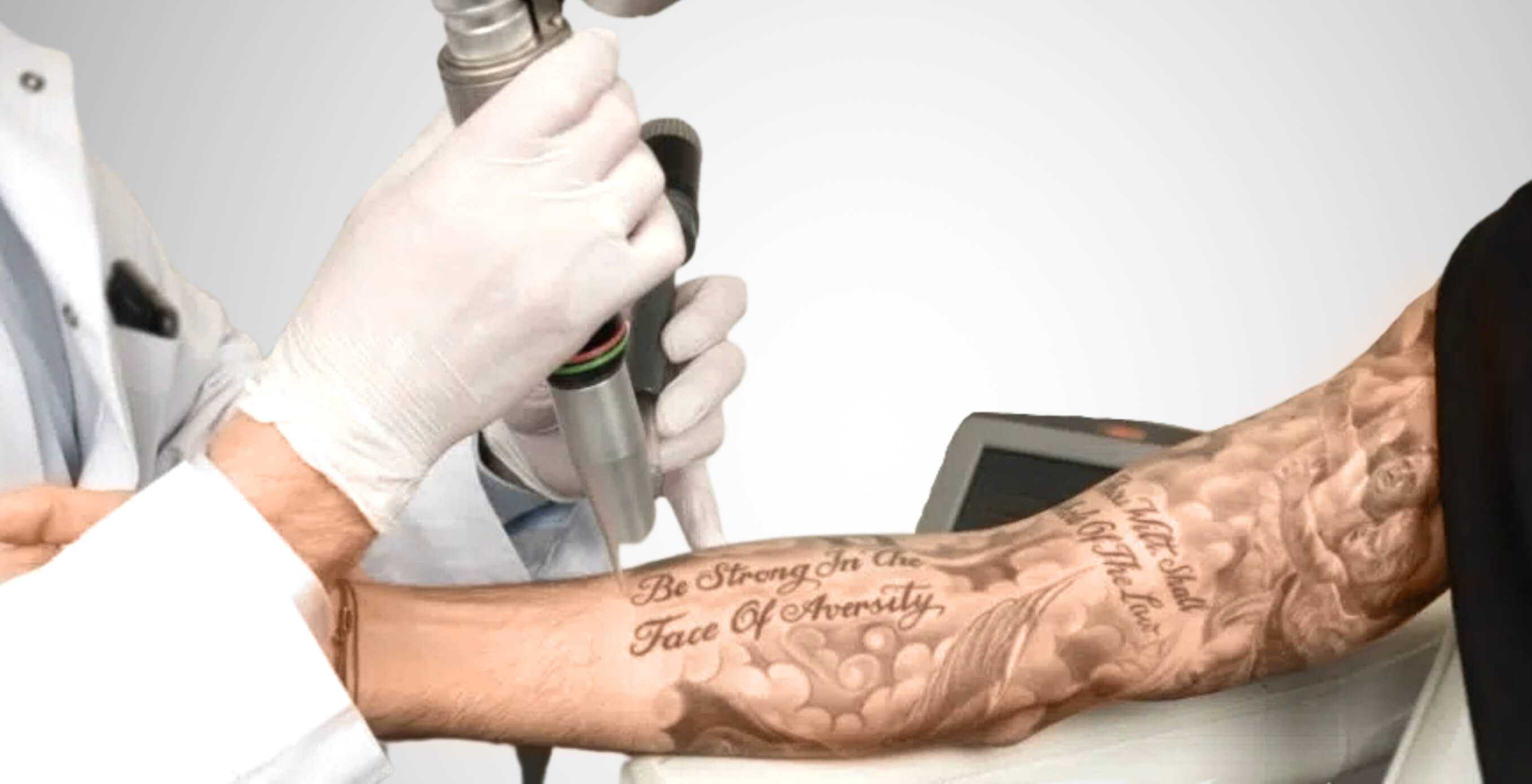Auf diesem Bild sieht man einen Mann der eine Tattooentfernung Wien erhaltet. Er möchte ein Tattoo am Arm entfernen lassen, dabe hält ein Fachpersonal einen Laser sorgfältig über die betroffene Stelle.
