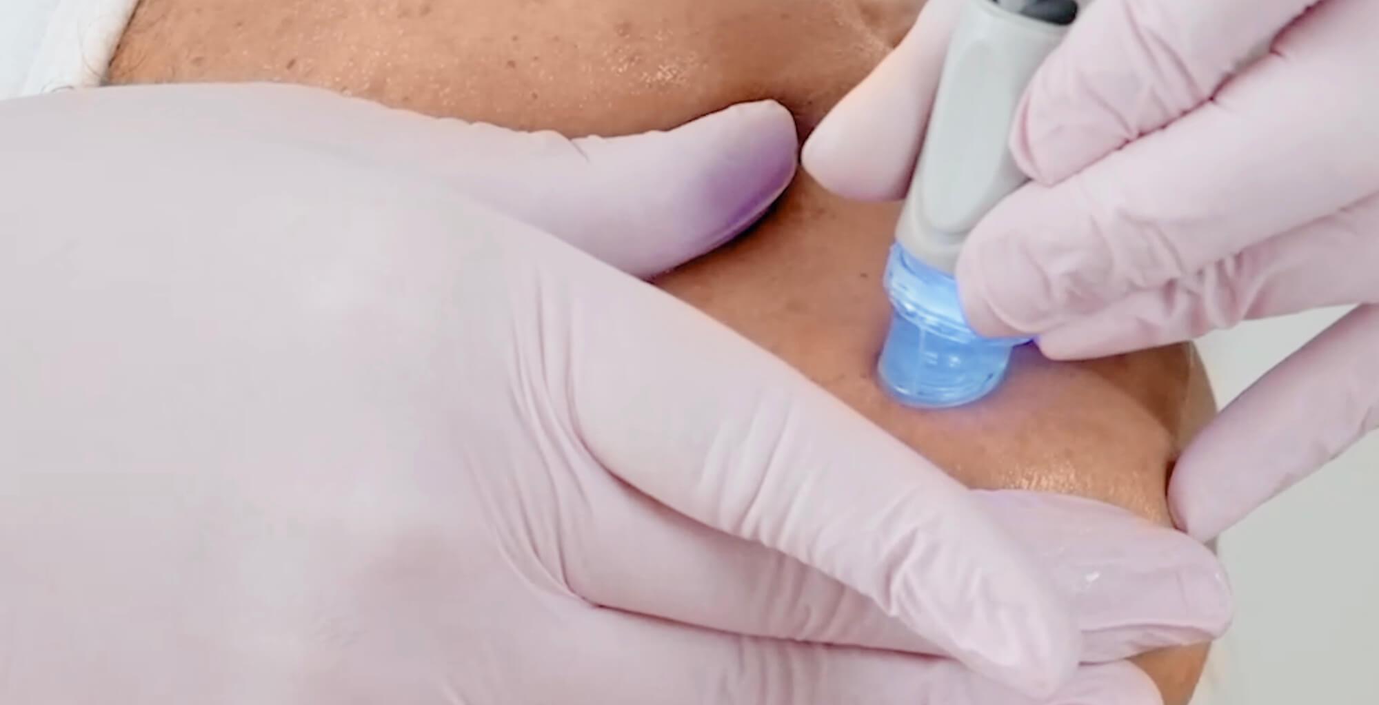 Hier sieht man Dermacares Tiefenreinigung im Sommer, eine Aquafacial Behandlung.