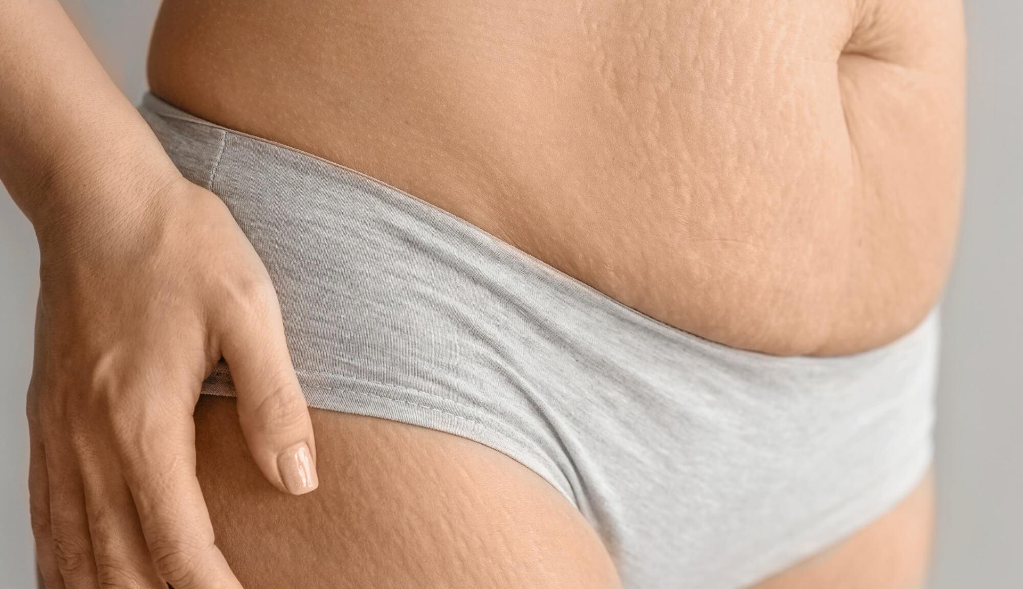 Auf dem Bild ist der Körper einer Frau zu sehen. Sie leidet sehr unter Dehnungsstreifen, womglich von der Schwangerschaft. Dermacare hat unzählige Behandlungen die gegen Dehnungsstreifen wirksam sind.