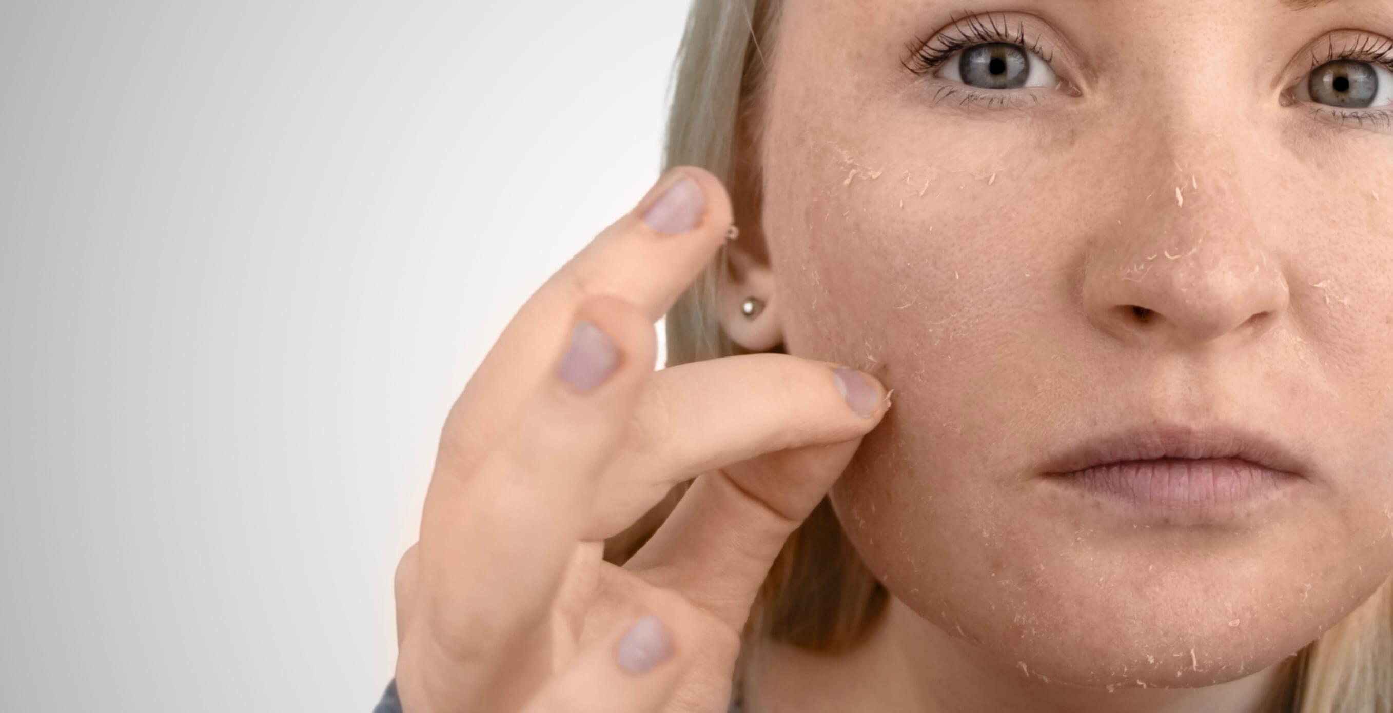 Trockene Haut im Winter: Dermatologin erklärt