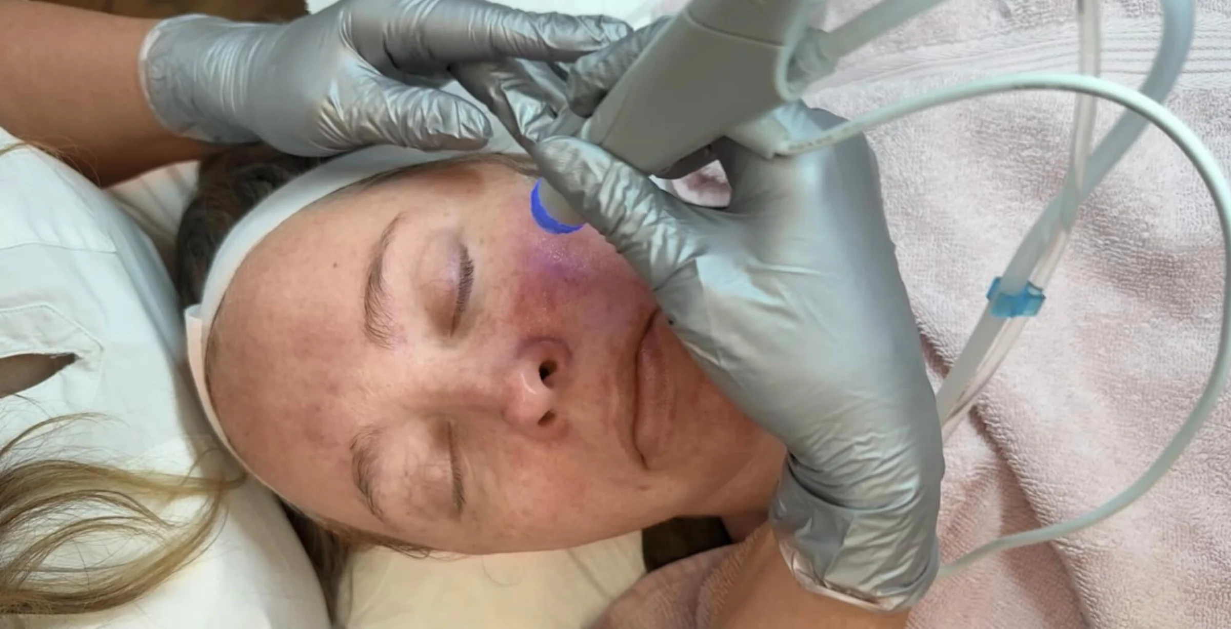 Das Bild zeigt wie Dermacare Wien dabei hilft ungeschminkt natürlich schön zu sein. Man sieht eine Frau die ein Aquafacial von Dermacares Fachpersonal erhaltet.