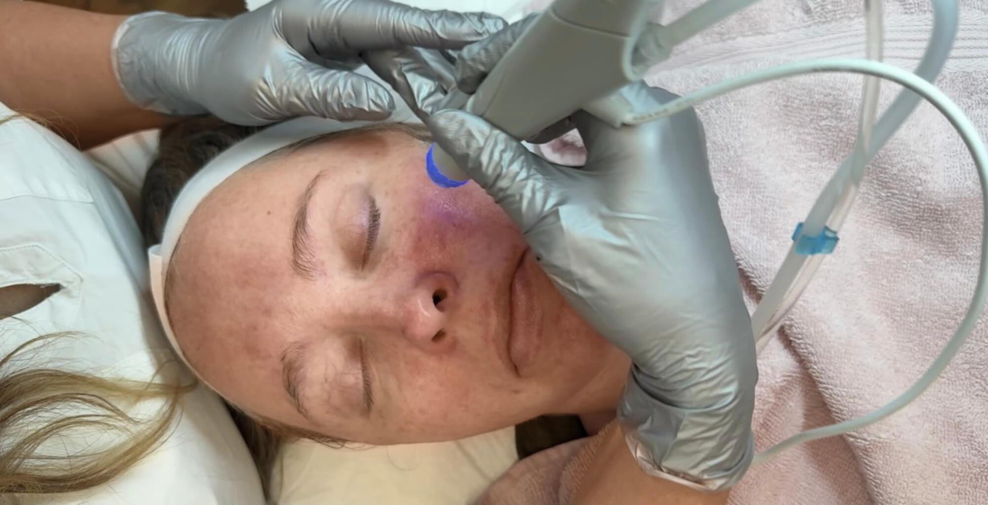 Das Bild zeigt wie Dermacare Wien dabei hilft ungeschminkt natürlich schön zu sein. Man sieht eine Frau die ein Aquafacial von Dermacares Fachpersonal erhaltet.