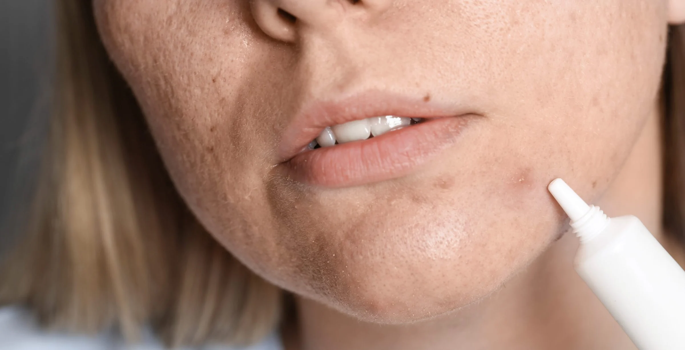 Unreine Haut durch Stress oder Hormone – so finden Sie die Ursache