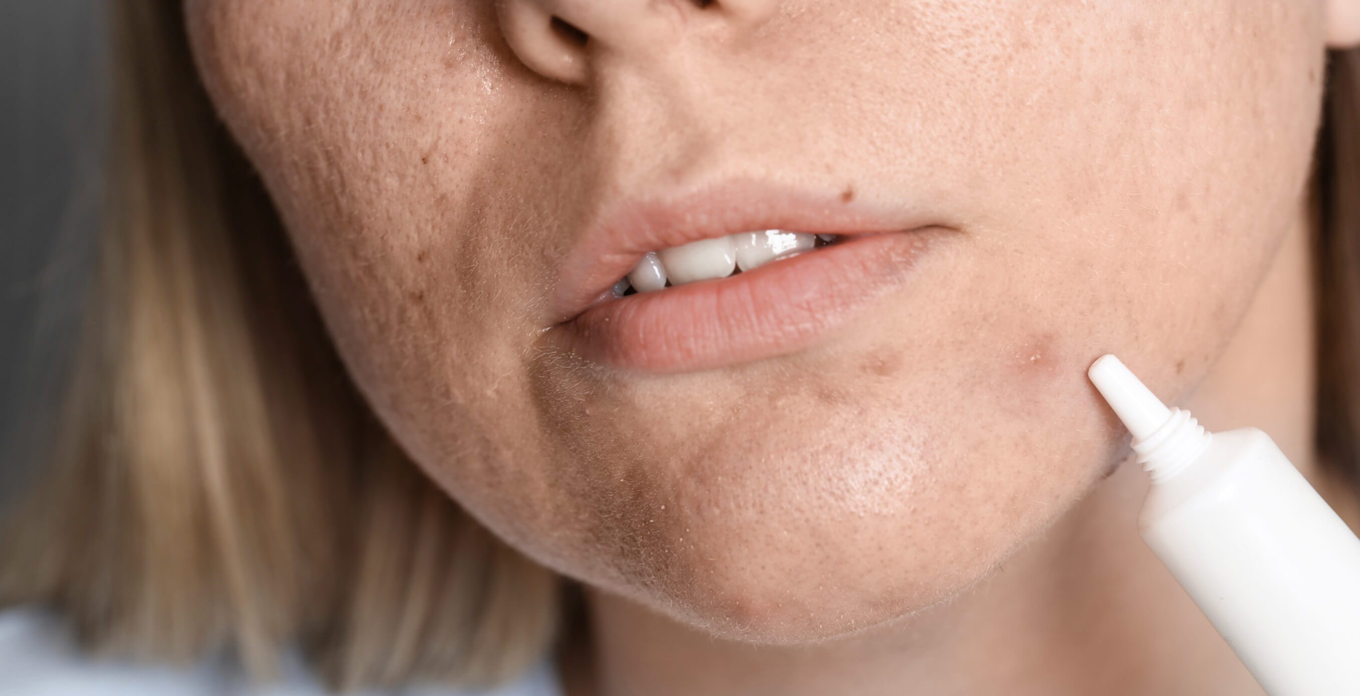 Unreine Haut durch Stress oder Hormone – so finden Sie die Ursache