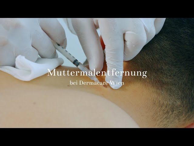 Muttermalentfernung bei Dermacare Wien