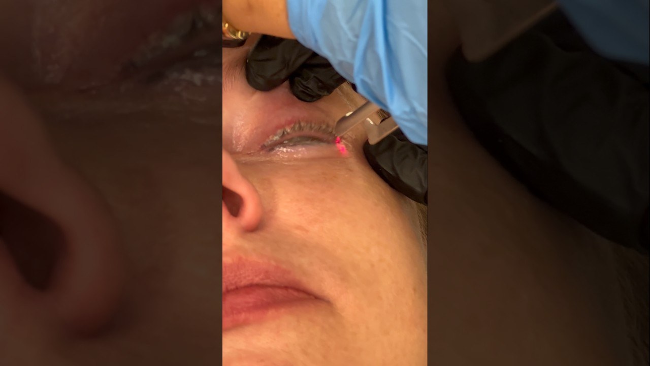 Lidstrich Permanent Make-up Entfernung mit dem Laser!