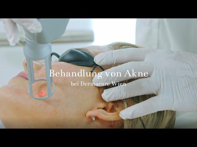 Behandlung von Akne bei Dermacare Wien