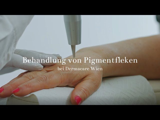 Behandlung von Pigmentflecken bei Dermacare Wien