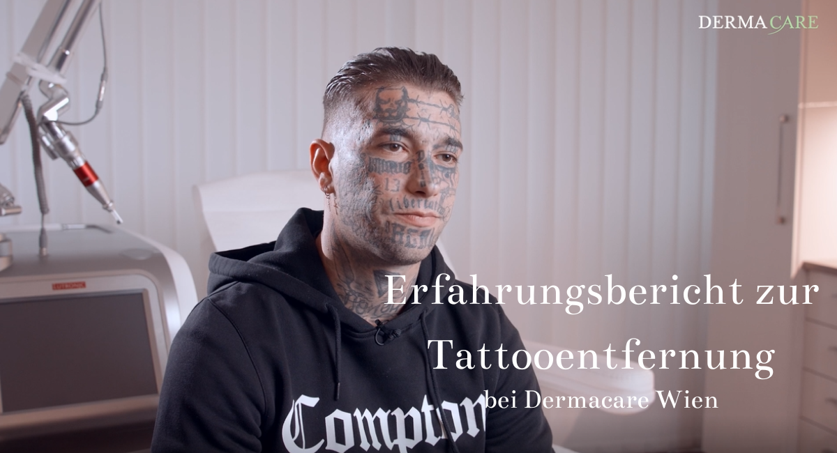 Tattooentfernung: Mann 2