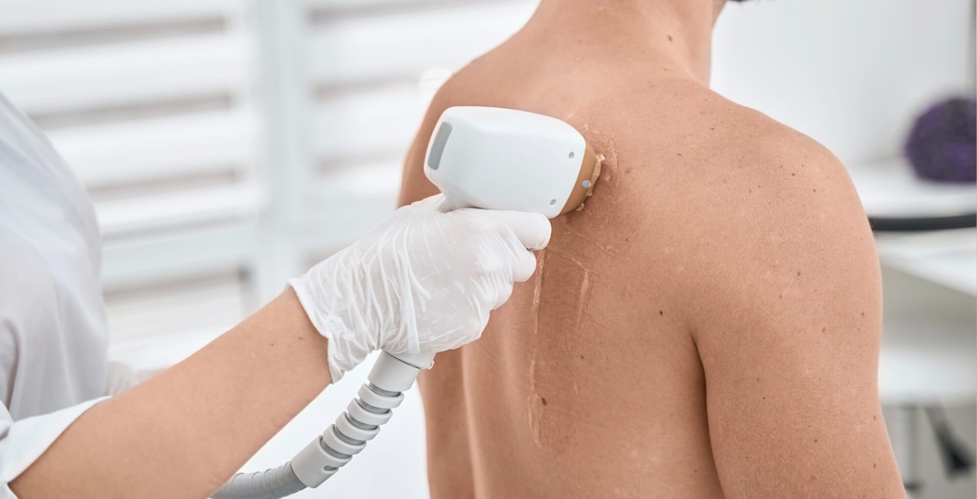 Ein Fachpersonal führt eine Laser-Haarentfernung am Rücken eines Mannes durch. Die professionelle Behandlung sorgt für eine glatte, haarfreie Haut durch dauerhafte Haarentfernung – auch an schwer erreichbaren Körperstellen.