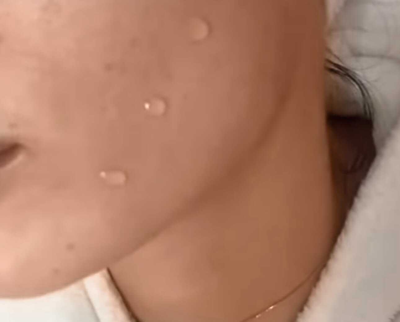 Das zweite Bild zeigt ein PQAge Peeling, ein sanftes, aber effektives professionelles Gesichtspelling von Dermacare Wien. Auf der Haut sind feine Tropfen einer Wirkstofflösung zu sehen, die tief in die Haut einwirken. Das PQAge Peeling kombiniert chemische und revitalisierende Komponenten, um die Hautstruktur zu verbessern, die Zellerneuerung anzuregen und einen strahlenden Teint zu erzeugen – ganz ohne Ausfallzeit.