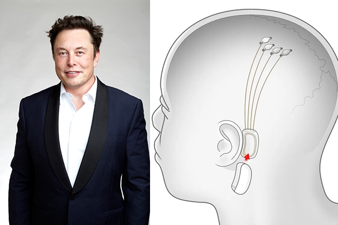 Elon Musk is developing a brain chip to stream music inside your head