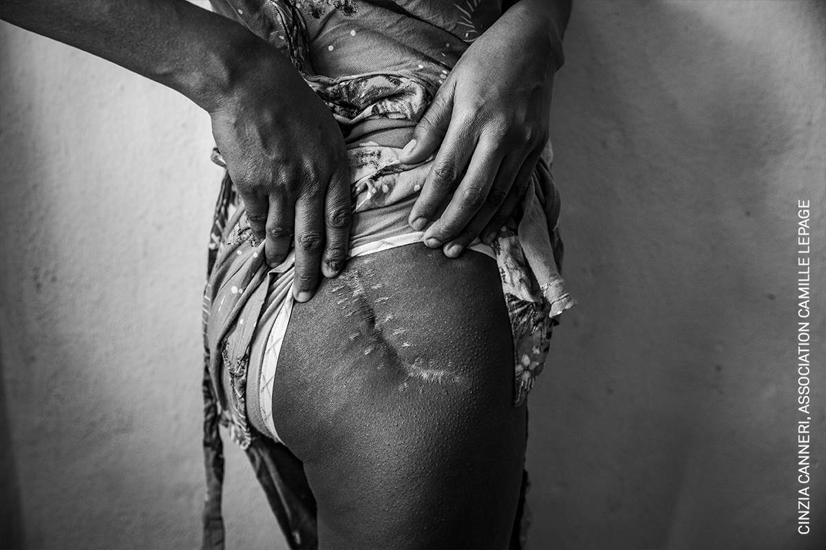 Monochrome image of scarred and roughened hands cradling a large rounded object, possibly a pregnant abdomen.