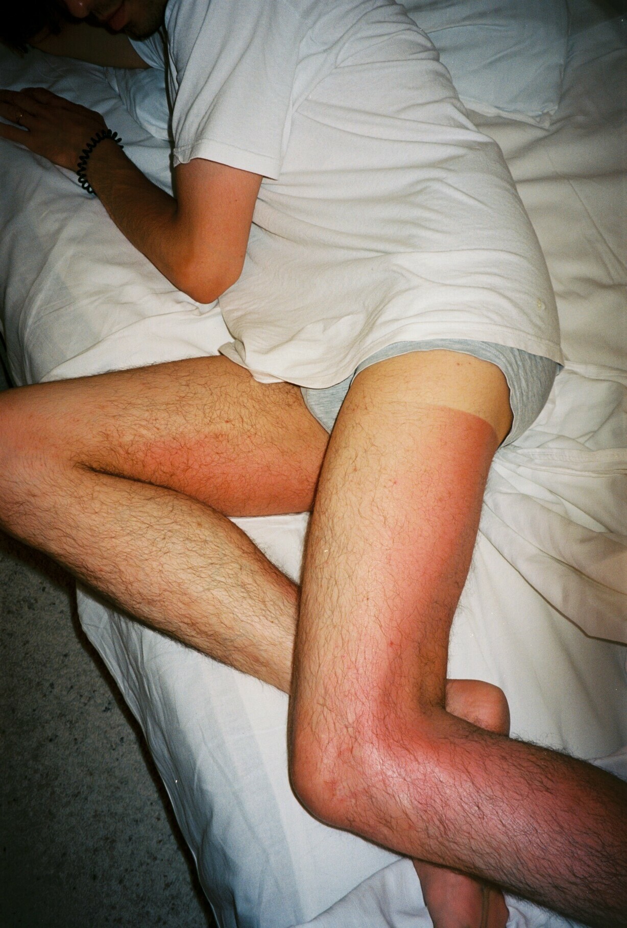 Arm and leg of a person on a hospital bed wrapped in white sheets.